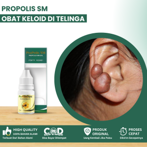 Obat Keloid Di Telinga Obat Benjolan Di Belakang Telinga Obat Penghilang Daging Tumbuh Di Daun Telinga Obat Keloid Bekas Tindik Obat Penghilang Keloid Bekas Luka Tindik Dengan Propolis SM