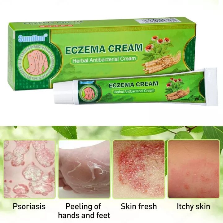 HOT SALE】Antibacterial Psoriasis Cream Herbal Treatment Eczema Relief ...