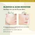 [ ANTI ACNE + ANTI DARK SPOT TONER ] Greenika Rejuvenating Toner Ultimate Solution to Whiteheads, Blackheads Clarifying Toner for Acne Toner for Pimples Acne Remover Toner Facial Rejuvenating Toner, Better than Any Acne Facial Toner Anti Acne Remover. 