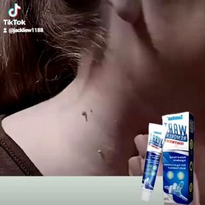 20g Wart Cream for Plantar Warts Removal Corn Skin Tag Warts Remover Ointment