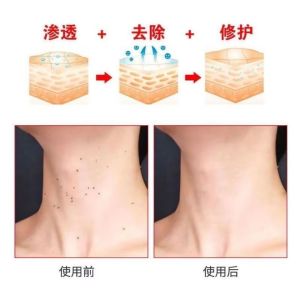 【正品】去脖子小肉粒祛丝状尤颈部赘皮克尤液腋下猴子温和去质膏【 Authentic 】 Neck Removing Small Meatballs Silk like Hair Removal Neck Scars Pike You Liquid Armpit Monkey Gentle Removing Cream