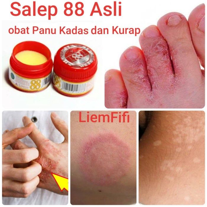 salep 88 (obat gatal, panu, kurap, kutu air, jamur, kadas, kurap) | Lazada