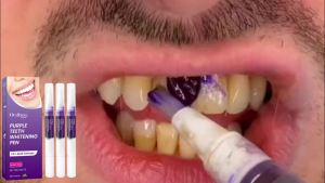 🚀 Shipping today  🚀Oralhoe  Purple Dental Care Pen   Clean Oral Smoke Stains Tea Stains Tooth Stains Fresh Comfortable Cleaning Tooth Pen