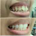 Alat untuk merapihkan gigi maju Alat perapih gigi tonggos original asli Perapih gigi maju ke depan Behel gigi lepas pasang karet murah Perapih gigi tonggos atas asli ginsul atas tidak rata asli Alat buat merapihkan gigi tonggos Teeth Trainer Alignment ORI. 