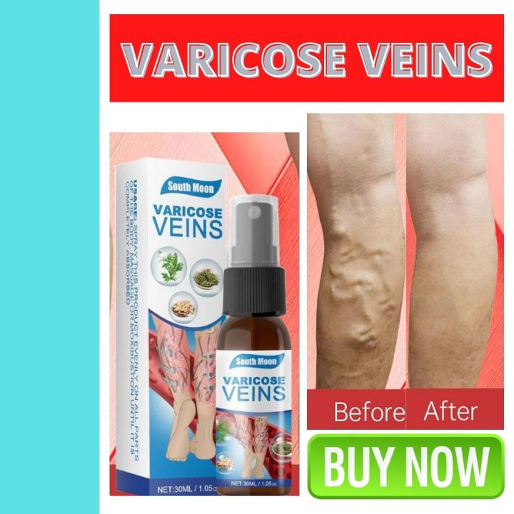 Varicose Veins Removal Healing Cream Ointment Intravenous Cream