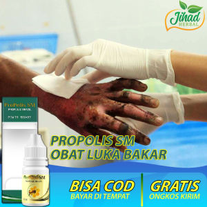 Obat Oles Luka Bakar Melepuh Kulit Mengelupas Infeksi Kulit di Kaki Tangan Wajah