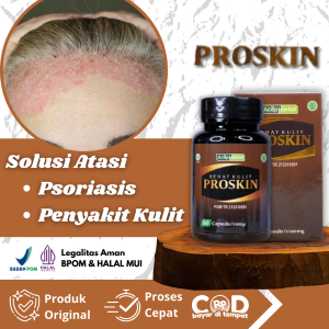 Obat Psoriasis Gatal Kulit Psoriasis Psoriasis Kulit Kepala Kulit Bersisik Dan Tebal Gatal Kulit Kepala Kulit Kering Koreng Di Kepala Psoriasis Kepala Kepala Bersisik Kulit Kepala Berkerak Ketombe Berkerak Dengan ProSkin