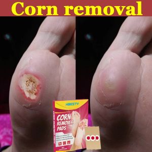 Plester Mata Ikan Plester Obat Kutil Foot Corn Removal Penutup Kutil Obat Mata Ikan Kapalan Caplak plaster Mata ikan Obat Kutil Plester Kutil Ampuh Jiyantie Plester mata ikan