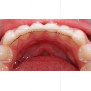 Gói 2 Thanh Duy Trì Cố Định Sau Chỉnh Nha - Thanh Duy Trì Mặt Lưỡi Nha Khoa