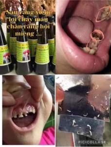 Lọ ngâm sâu răng của nười dao đỏ Sapa dùng cho người đau răng vi êm lợi hôi miệng