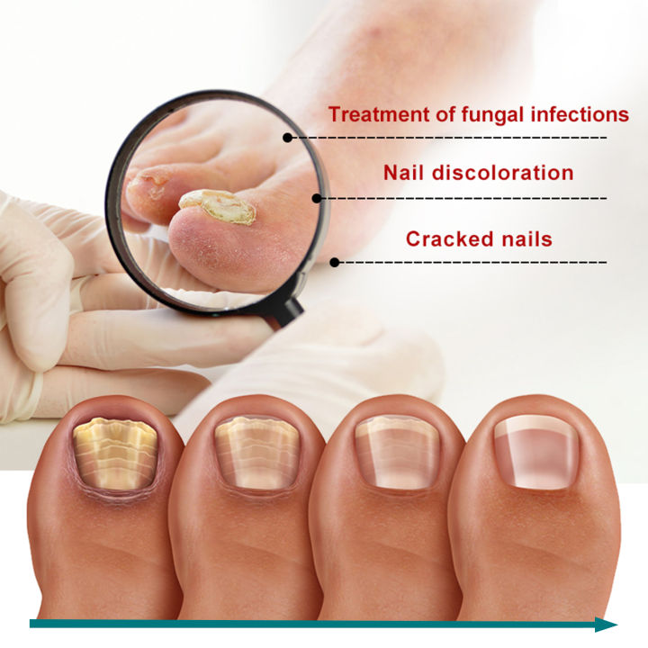 %E3%80%90100%25%20Effective%E3%80%91Jaysuing%20Fungal%20Nail%20Treatment%20Patch%20Anti%20Infection%20Paronychia%20Thickening%20Soft%20Waterproof%2032pcs%20-%20Image%208