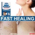 Plester Kutil Mata Ikan untuk Kaki Kapalan Foot Corn Removal Plaster Koyo Penghilang Mata Ikan12pcs plester mata ikan,obat mata ikan di telapak kaki,plaster mata ikan. 