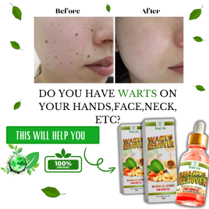 Kasoy Oil Warts Remover Natural Mole Remover 15 mL Warts are contagious remove it naturally w/out surgery this facial serum proven safe & effective. It effectively removes skin tag moles warts (kulugo) milia (syringoma) & calluses (kalyo).