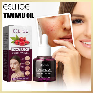 Eelhoe Qiongya Begonia essence Oil Eliminates Acne Closes the Mouth Repairs Sensitive Muscles and Facial essence  Deep Anti Wrinkle Serum Anti Aging Moisturizing Whitening Fine Line Lift  Essential Oil