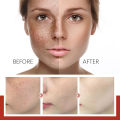 EELHOE Pigment Correcting Cream Freckles Removal Cream Pigment Correcting Serum Remove Melasma Age Spots Sunspots Whitening Freckle Removing Cream Effective Brightening Essence Remove Pigment Melanin Correct Beauty Facial Skin Care. 