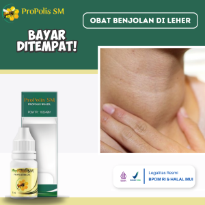 Obat Benjolan Di Leher Obat Oles Penghilang Benjolan Di Leher Obat Tiroid Membesar Obat Kelenjar Tiroid Obat Leher Sakit Obat Penghancur Lipoma Obat Kelenjar Di Leher Benjolan Keras Dan Berair Dengan Propolis SM