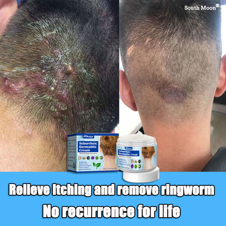 【100 Effective】South Moon Psoriasis Treatment Cream,Repair Seborrheic