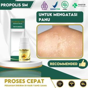 Obat Penghilang Panu Di Wajah Muka Punggung Kaki Dengan Propolis SM