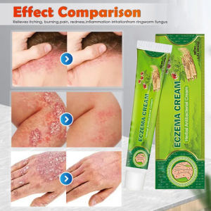 Skin Problems Treatment Eczema Cream Dermatitis Cream Antibacterial Cream Eczema Ointment Psoriasis Balm Skin Rash Cream Used to treat fungal skin infections such as ringworm (buni) athletes foot(alipunga) fungal nappy rash and fungal sweat rash.