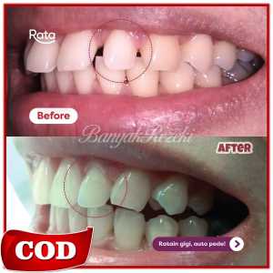 {TAHAP 2} Alat perapih gigi tonggos original asli Alat perapih gigi kedepan Perapih gigi tidak rata Teeth Trainer Alignment Alat perapih gigi karet Alat untuk merapikan gigi tonggos Alat perapat gigi renggang ampuh Alat perapat gigi warna putih