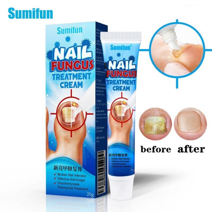 Sumifun 20gNail Treatment Essential Ointment Remove Onychomycosis ...