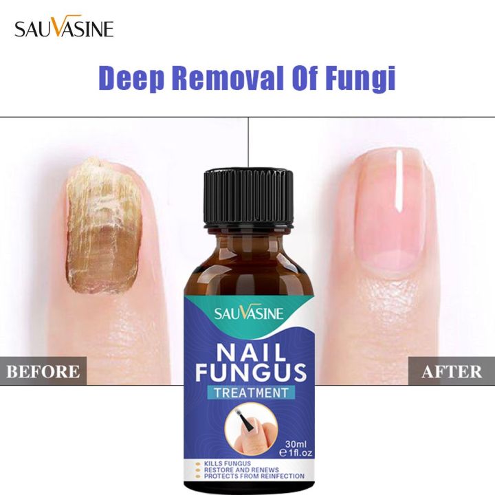 Sérum Réparateur Pour Ongles - Traitement Antifongique Contre La Mycose