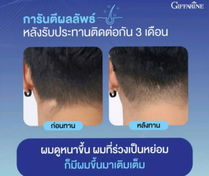 %E0%B9%84%E0%B8%9A%E0%B9%82%E0%B8%AD%E0%B8%95%E0%B8%B4%E0%B8%99%20%E0%B9%80%E0%B8%AD%E0%B8%8A%20%E0%B8%9E%E0%B8%A5%E0%B8%B1%E0%B8%AA%20%E0%B8%81%E0%B8%B4%E0%B8%9F%E0%B8%9F%E0%B8%B2%E0%B8%A3%E0%B8%B5%E0%B8%99%20Biotin%20H%20Plus%20%20%E0%B9%84%E0%B8%9A%E0%B9%82%E0%B8%AD%E0%B8%95%E0%B8%B4%E0%B8%99%20%E0%B9%80%E0%B8%AD%E0%B8%8A%20%E0%B8%9E%E0%B8%A5%E0%B8%B1%E0%B8%AA%20%E0%B9%84%E0%B8%A1%E0%B9%88%E0%B8%AD%E0%B8%A2%E0%B8%B2%E0%B8%81%E0%B9%80%E0%B8%AA%E0%B8%B5%E0%B8%A2%E0%B9%83%E0%B8%88%20%E0%B8%AD%E0%B8%A2%E0%B9%88%E0%B8%B2%E0%B8%9B%E0%B8%A5%E0%B9%88%E0%B8%AD%E0%B8%A2%E0%B9%83%E0%B8%AB%E0%B9%89%E0%B8%8A%E0%B8%B5%E0%B8%A7%E0%B8%B4%E0%B8%95%E0%B8%82%E0%B8%B2%E0%B8%94..%E0%B8%9C%E0%B8%A1%20%20%E0%B8%97%E0%B8%A7%E0%B8%87%E0%B8%84%E0%B8%B7%E0%B8%99%E0%B8%9C%E0%B8%A1%E0%B9%81%E0%B8%82%E0%B9%87%E0%B8%87%E0%B9%81%E0%B8%A3%E0%B8%87%E0%B8%AA%E0%B8%B8%E0%B8%82%E0%B8%A0%E0%B8%B2%E0%B8%9E%E0%B8%94%E0%B8%B5%20-%20Image%208