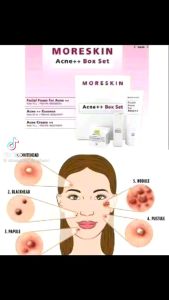 MORESKIN ACNE SERIES | Paket Moreskin acne++ | Paket Jerawat Khusus Moreskin acne