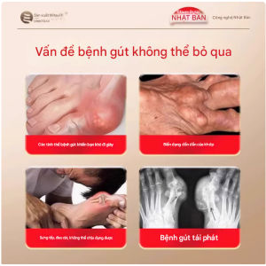 Kem Giảm đau khớp tay khuỷu chân Gout lưu thông máu ứ đọng khớp ngón tay