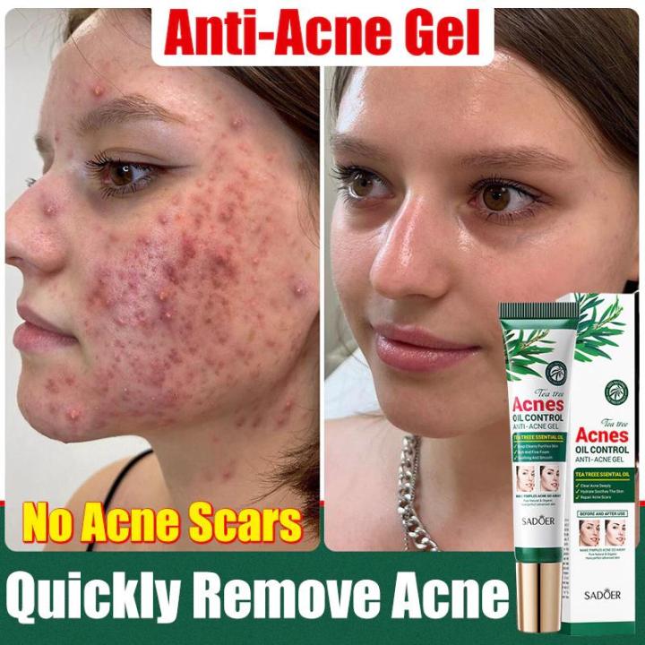 Acne cream Pimple cream treatment Acne serum Acne gel Acne 20g Krim ...