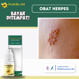 Obat Herpes Obat Herpes Zoster Obat Herpes Kulit Obat Penyakit Herpes Obat Herpes Genital Obat Gatal Berair Obat Herpes Bernanah Obat Luka Lepuhan Herpes Sakit Dan Perih Dengan Propolis SM