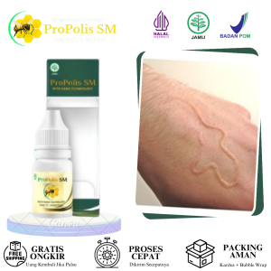Obat Cutaneous Larva Migrans Infeksi Cacing Kulit Larva Cacing Tambang Penyakit Cacingan / Ascariasis Penghilang Cacing di Bawah Kulit Anak & Dewasa Dengan ProPolis SM
