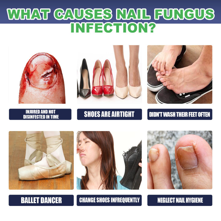 Uhoe Onychomycosis Repair Drops Hand and Foot Onychomycosis Soft Nail ...