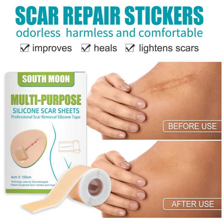 JKS%EF%BC%884*150cm%EF%BC%89South%20Moon%20Silicone%20Scar%20Sheet%20High%20Efficiency%20Surgical%20Silicone%20Gel%20Tape%20Removal%20Scar%20Tape%20Treatment%20-%20Image%205