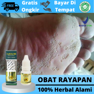 Obat Kaki Rayapan Dan Bau Menghilangkan Kaki Rayapan Parah Pitted Kerotolysis Penghalus Dampal Kaki Kasar Kering Obat Oles Tumit Kaki Pecah Pecah Telapak Kaki Bolong Berlubang Rorombeheun Gatal Kutu Air Di Sela Jari Kaku - Propolis Sm Terbukti