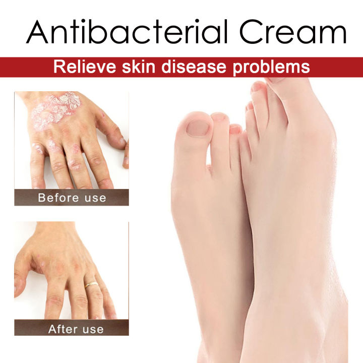 South Moon Antibacterial Cream Psoriasis Antibacterial Ointment Anti ...