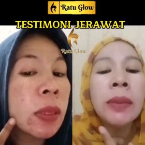 RATU GLOW SERIES 5 IN 1 FLEK HITAM/JERAWAT HILANG KAN