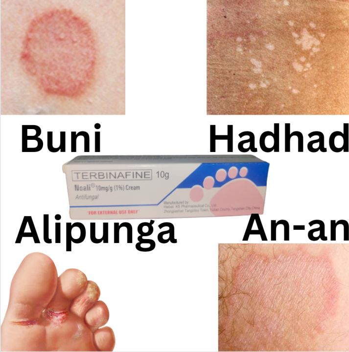 Terbinafine Antifungal Cream Mabisa sa Buni Hadhad An-an at 