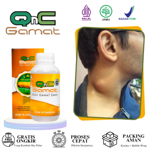 Obat Benjolan Di Leher Kelenjar Getang Bening Benjolan Uci Uci Kanker Tumor Kelenjar Tiroid Lipoma Godongan / Gondok Pada Anak dan Dewasa Dengan QnC Jelly Gamat Original