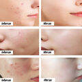 Acne Cream whitening moisturizing cream acne removal essence 30g facial essence cream scar acne remo Pimple Eraser. 