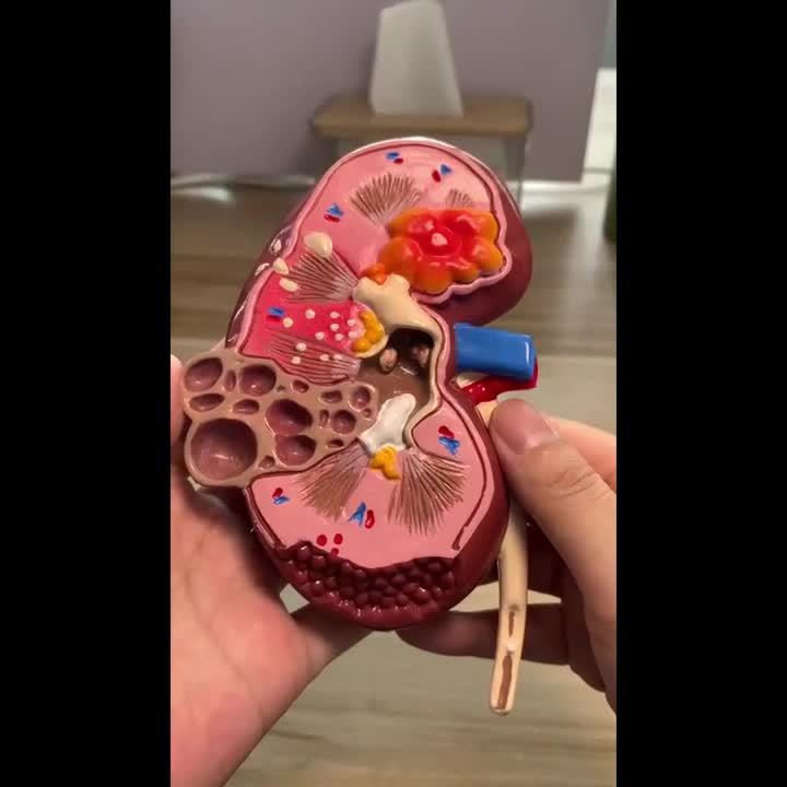 1 Pcs Life Size Kidney Pathologies Model Human Body Anatomy of Diseased