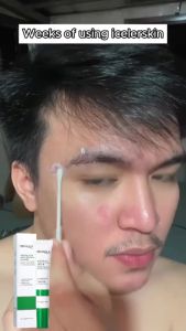 BIOAOUA Salicylic Acid Acne Removal Cream