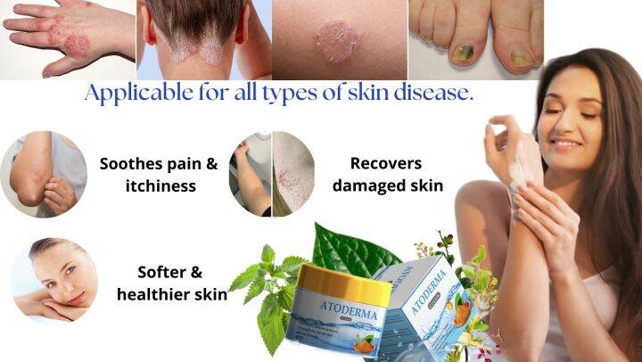 ATODERMA (DERMATITIS, ALERHIYA, PANTAL, URTICARIA, DERMATITIS PLANTARIS SICCA, HALAMANG-SINGAW SA BALAT...) cream