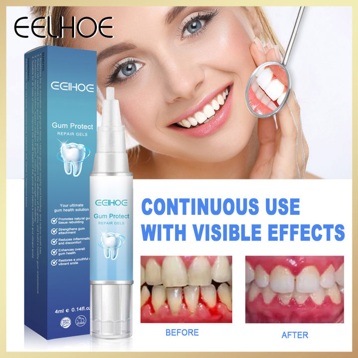 Eelhoe Tooth Gum Repair Gel Quick Repair Of Cavities Caries Rebuilding 