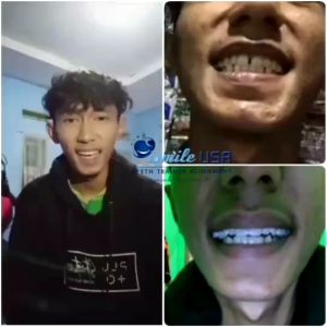perapih gigi original ismile usa / teeth trainer / teethtrainer alignment / perapi gigi / perapi gigi original / alat perapi gigi /  alat merapikan gigi / perapi gigi tonggos / perapi gigi rengang / perapat gigi /  perapih gigi asli
