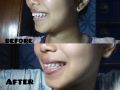 [TAHAP 1] Perapih gigi tonggos original asli Perapih gigi maju ke depan Behel gigi lepas pasang asli original Behel perapih gigi carang gingsul renggang asli dokter Alat perapih gigi monyong Alat perapih gigi maju ori Teeth Trainer Alignment Asli 100% ORI. 