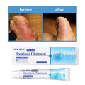 Psoriasis Antibacterial Ointment Topical Skin Ointment Inhibit Bacteria Relieve Itching Dermatitis Eczema Itchy Skin. 