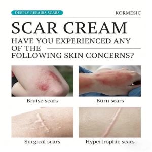 Best-Selling 50g Japanese Formula Scar Gel Fade Old Leg Scars Stretch Marks Pampatanggal Ng Peklat Gentle Skin Repair COD