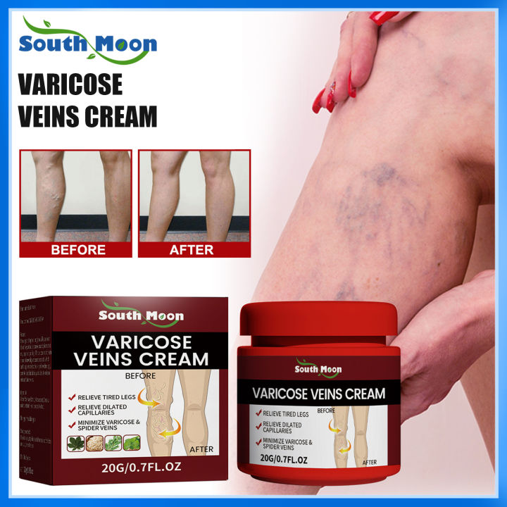 South Moon Varicose Veins Cream Medical Plaster Improves Blood 