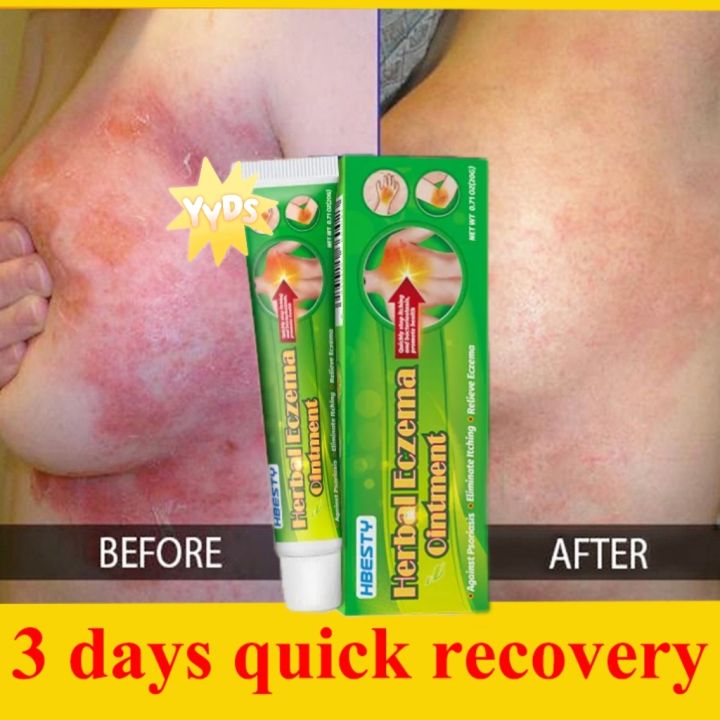 Quick Relief Itching Eczema Treatment Cream 20g Private parts ...